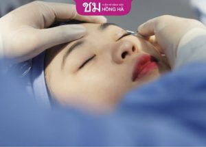 Top bác sĩ cắt mí uy tín – 4 Tiêu chí cần đảm bảo