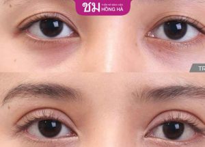 Bấm mí – Giải pháp giúp đôi mắt to tròn, đẹp chuẩn Thái