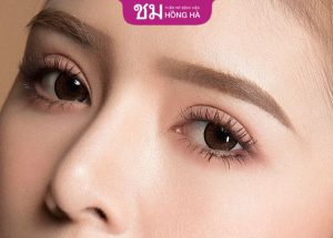 Bấm mí ăn gì? Kiêng gì? Giải đáp từ bác sĩ BV Hồng Hà