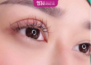 Bấm mí mắt có bị sưng không – Cách chăm sóc sau cắt mí mắt