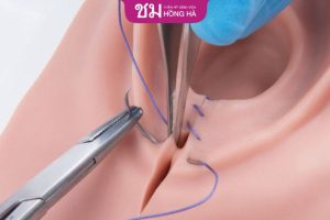 Bảng giá thẩm mỹ vùng kín: Bí quyết giảm thiểu chi phí tân trang