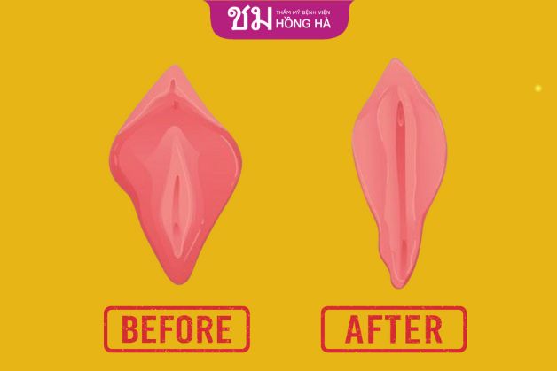 Giá thẩm mỹ vùng kín phụ thuộc vào công nghệ thực hiện