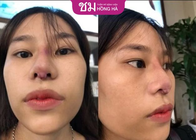 Bị sẹo lồi sau khi nâng mũi