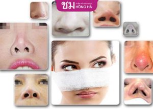 5 Biến chứng sau nâng mũi và cách xử lý hiệu quả