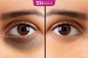 9+ Cách trị thâm quầng mắt vĩnh viễn chỉ sau 1 đêm