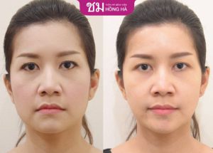 Căng chỉ da mặt bao lâu thì đẹp – 4 Cách kéo dài hiệu quả