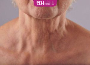 Căng da cổ nội soi: Bí quyết xóa 90% nếp nhăn vùng cổ