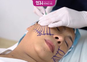 Thẩm mỹ căng da mặt – Đỉnh Cao Trẻ Hóa Không Xâm Lấn