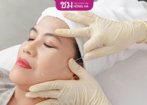 Căng da mặt bằng chỉ  | An toàn | Không sẹo