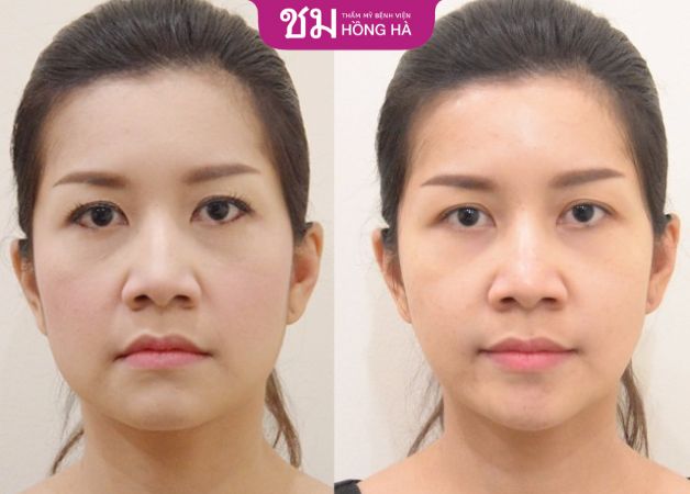 Chi phí căng da mặt bằng chỉ