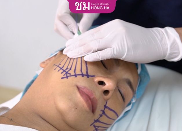 Căng da mặt bằng chỉ có đau không? Chuyên gia thẩm mỹ giải đáp