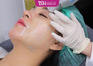 Căng da mặt bằng chỉ giá bao nhiêu? 3 Yếu tố ảnh hưởng