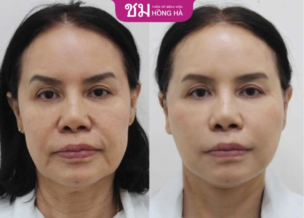 CĂNG DA MẶT TẠI BỆNH VIỆN 108 VỚI KỸ THUẬT TIÊN TIẾN