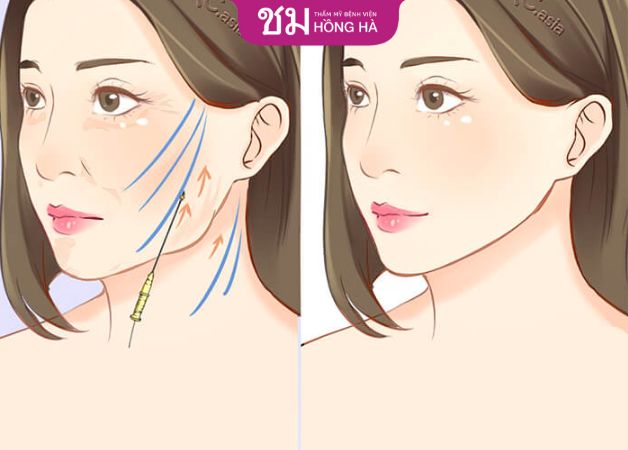 Căng da vùng thái dương bằng chỉ