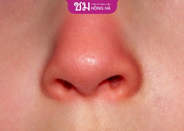 3-4 ngày đầu vùng mũi có dấu hiệu sưng tấy