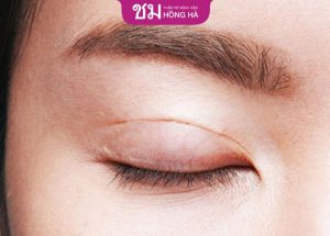 Cắt  mí có để lại sẹo không – 3 yếu tố gây sẹo xấu khi cắt mí