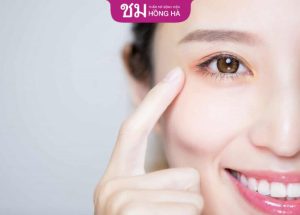 Cắt mí dưới có để lại sẹo không – Lưu ý ngừa sẹo hiệu quả
