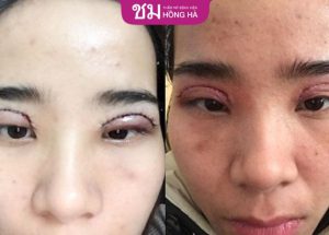 Cắt mí hỏng: Cách nhận biết và khắc phục hiệu quả nhất