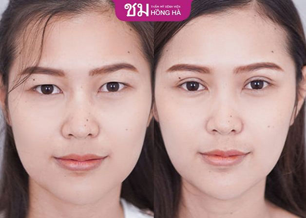 Hình ảnh trước và sau khi cắt mí mắt