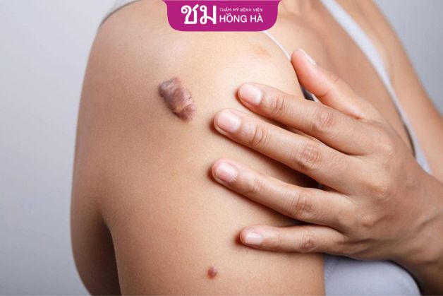 Kỹ thuật vi phẫu cắt bỏ sẹo lồi ở chân, tay