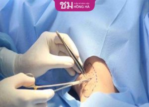 Cắt tuyến mồ hôi nách: Những nguy cơ tiềm ẩn bạn có biết?