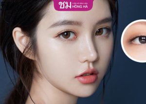 Tổng hợp 8 câu hỏi nhấn mí thường gặp – Bác sĩ giải đáp