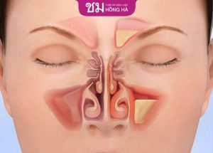 Cấu tạo mũi: Ảnh hưởng đến cấu trúc và chức năng của mũi không?