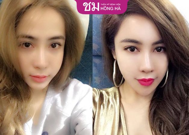 Gương mặt trẻ trung hơn khi làm đầy mỡ mặt