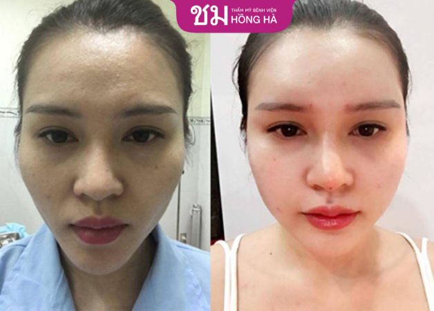 Khách hàng trước và sau khi làm đầy rãnh mũi má