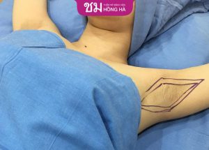 Chi phí hút nội soi tuyến mồ hôi nách tận gốc tại Hồng Hà