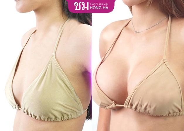 Khách hàng lột xác với vòng ngực đẹp quyến rũ