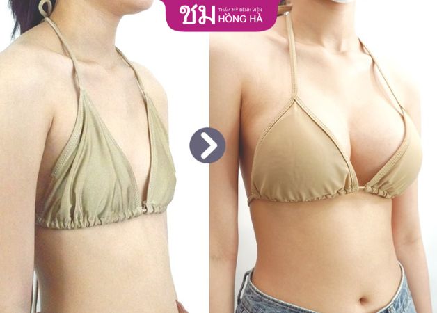 Tạm biệt ngực lép sau khi nâng ngực tại Thẩm mỹ Bệnh viện Hồng Hà