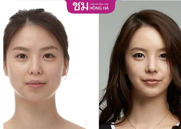 Phẫu thuật hàm hô móm nguy hiểm không - khẳng định gây nguy hiểm