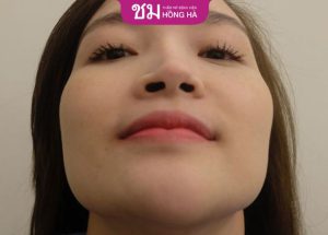 Chỉnh hình mũi phức tạp là gì? Quy trình thực hiện thế nào?