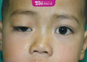 Chỉnh hình sụp mí mắt bẩm sinh khắc phục khuyết điểm hiệu quả