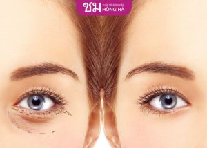 Chỉnh hình trễ mí dưới: Trẻ hóa đôi mắt như tuổi đôi mươi