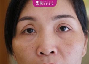 Chỉnh sửa mí mắt hỏng sau phẫu thuật- Lưu ý cần biết