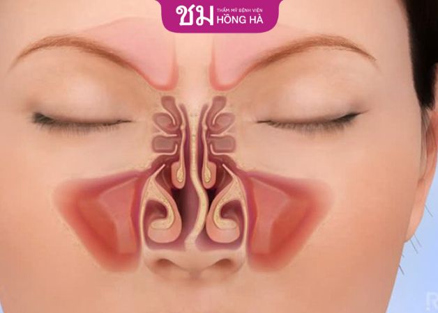 Lệch vách ngăn mũi ở mức độ nhẹ không ảnh hưởng đến sức khỏe