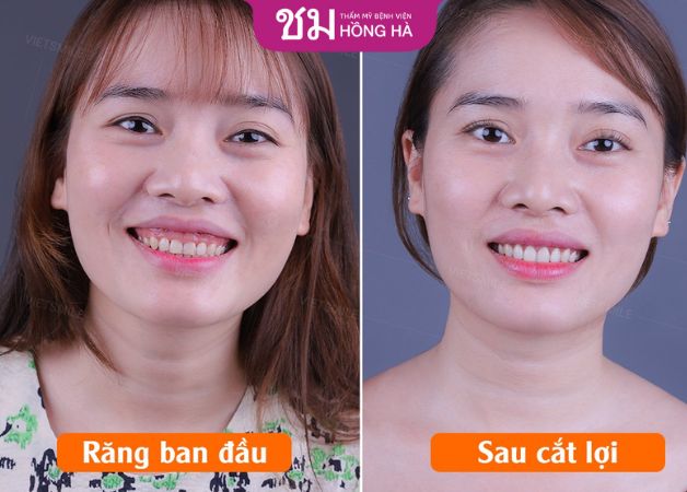 Lột xác với nụ cười rạng rỡ