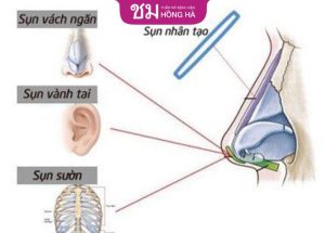 Có nên nâng mũi bằng bọc sụn không và những điều cần biết