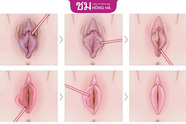 Ưu điểm và nhược điểm khi thẩm mỹ vùng kín