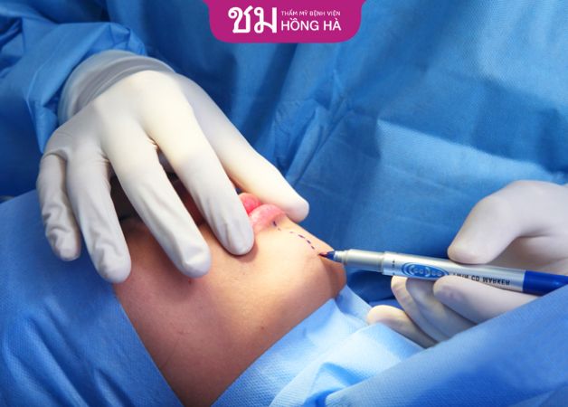 Bác sĩ thực hiện độn cằm bằng sụn tự thân