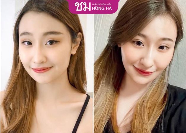 Thẩm mỹ Bệnh viện Hồng Hà - Địa chỉ độn cằm và gọt hàm Thái Lan uy tín