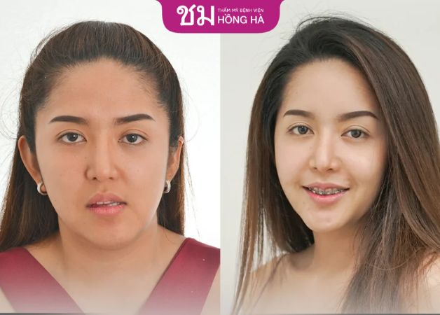 Khách hàng tự tin hơn sau khi độn cằm tại Hồng Hà
