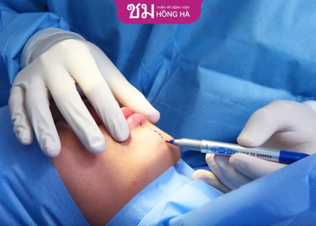 Bác sĩ độn cằm và gọt hàm Thái Lan tay nghề cao, giàu kinh nghiệm sẽ có chi phí thực hiện cao hơn