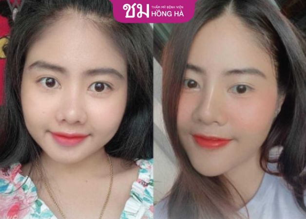 Hình ảnh độn cằm của khách hàng tại Hồng Hà