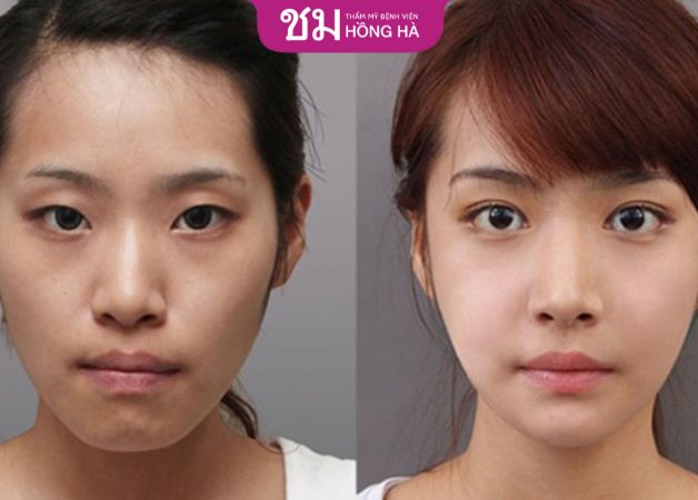 Cằm thon gọn sau khi thực hiện độn cằm và gọt hàm Thái Lan