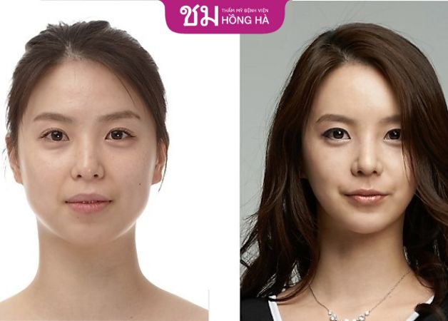 Gương mặt V Line chuẩn xu hướng giúp khách hàng lột xác ngoạn mục