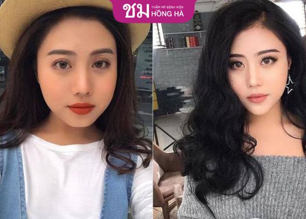 Khách hàng sở hữu khuôn mặt đẹp, thon gọn