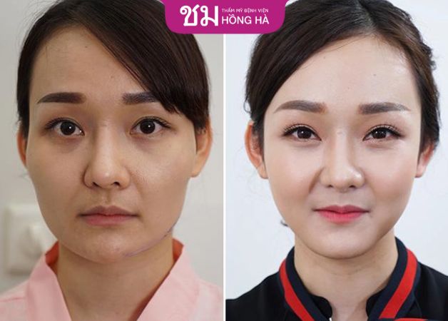 Khách hàng trước và sau khi độn cằm và gọt hàm Thái Lan tại Hồng Hà